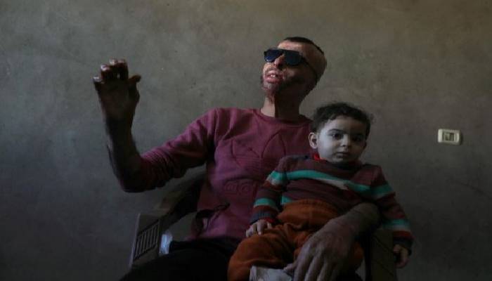 Gaza burn victims get 3D-printer face masks made close to home