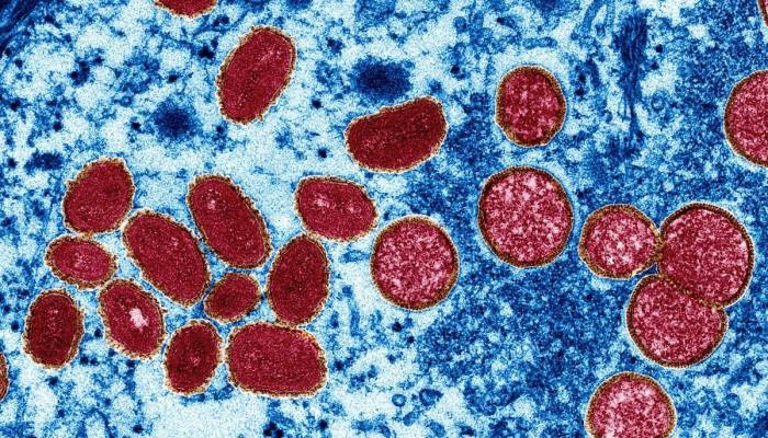 Turkish passenger with rashes not a Monkeypox case