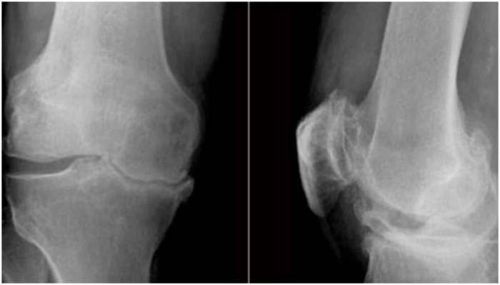 Common treatment for knee osteoarthritis 'ineffective': study