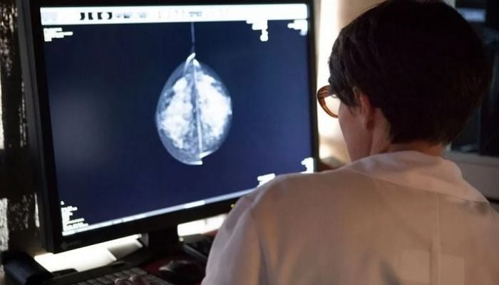 AI offers huge promise on breast cancer screening
