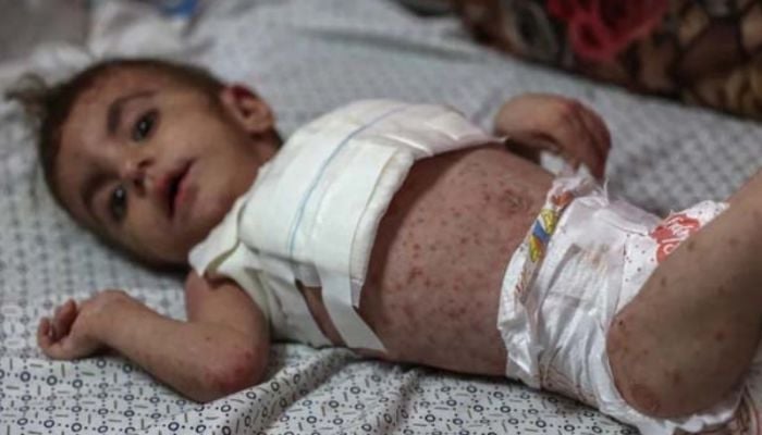 Dangerous skin diseases spreading among Gaza children