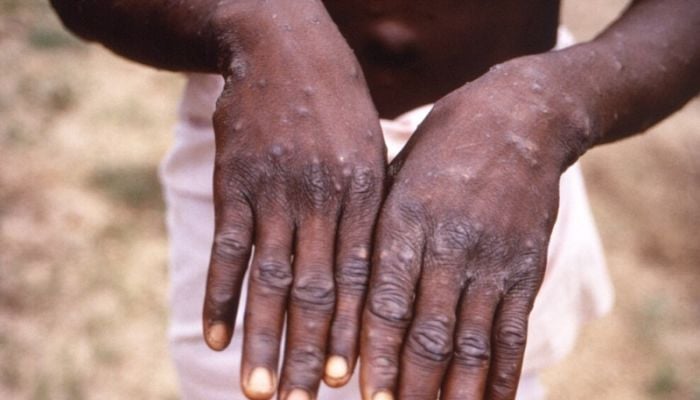 Which countries have reported mpox cases so far?