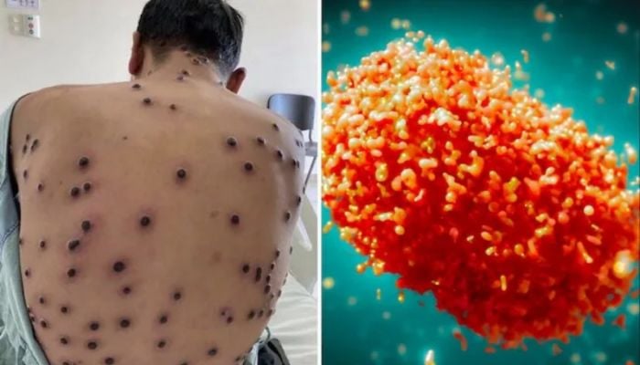 New mpox strain mutating very rapidly