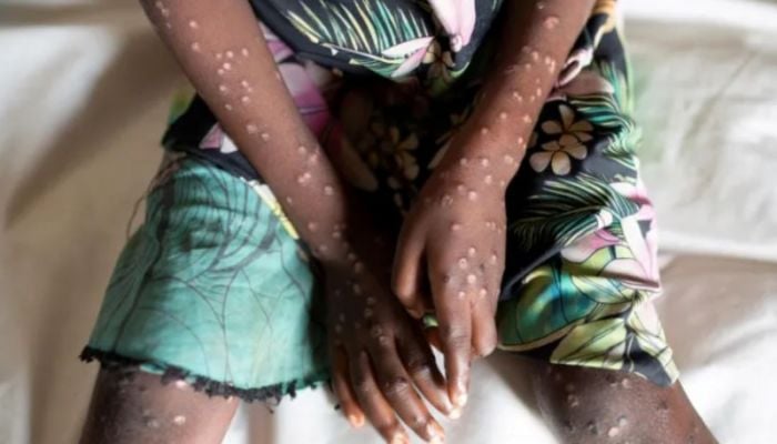 WHO declares monkeypox global health emergency