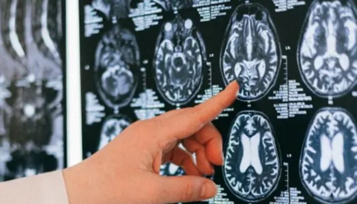 Alzheimer's disease connected to light pollution: Research