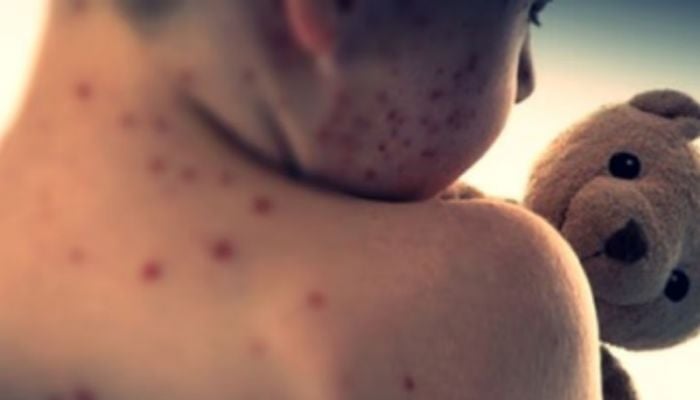 Measles outbreak kills 8 children in Israel