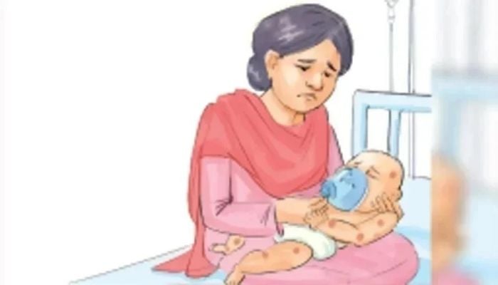Seven more die from measles symptoms